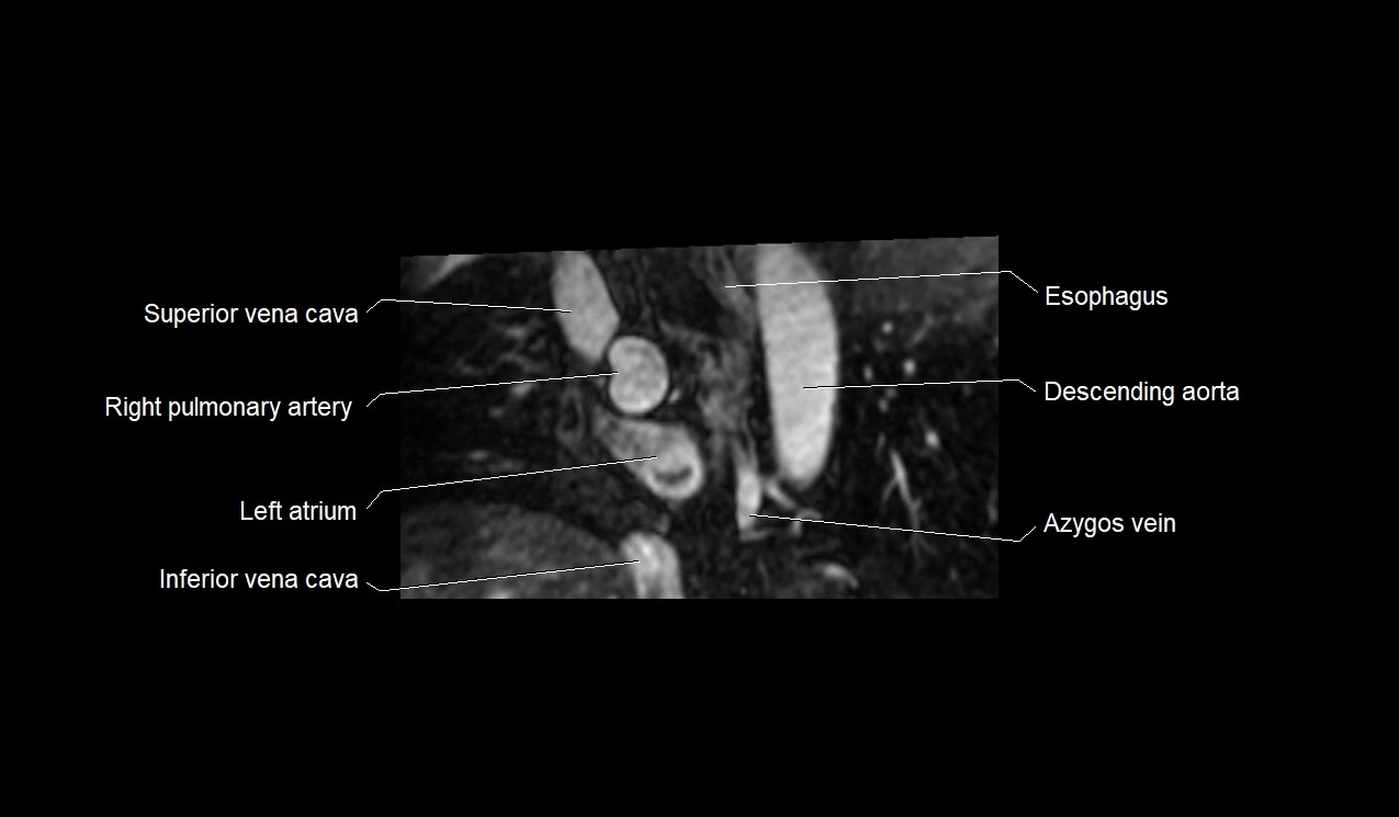 MRI heart and coronary arteries short axis anatomy image 3.webp
